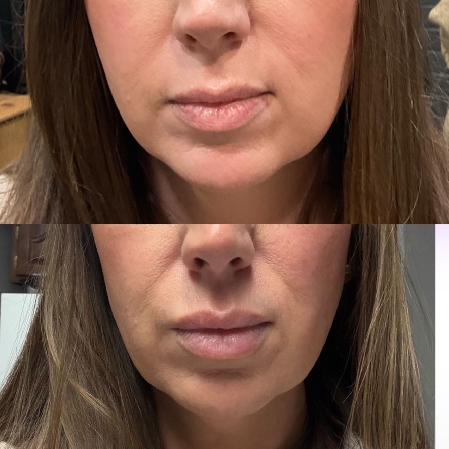 Dermal filler result 8