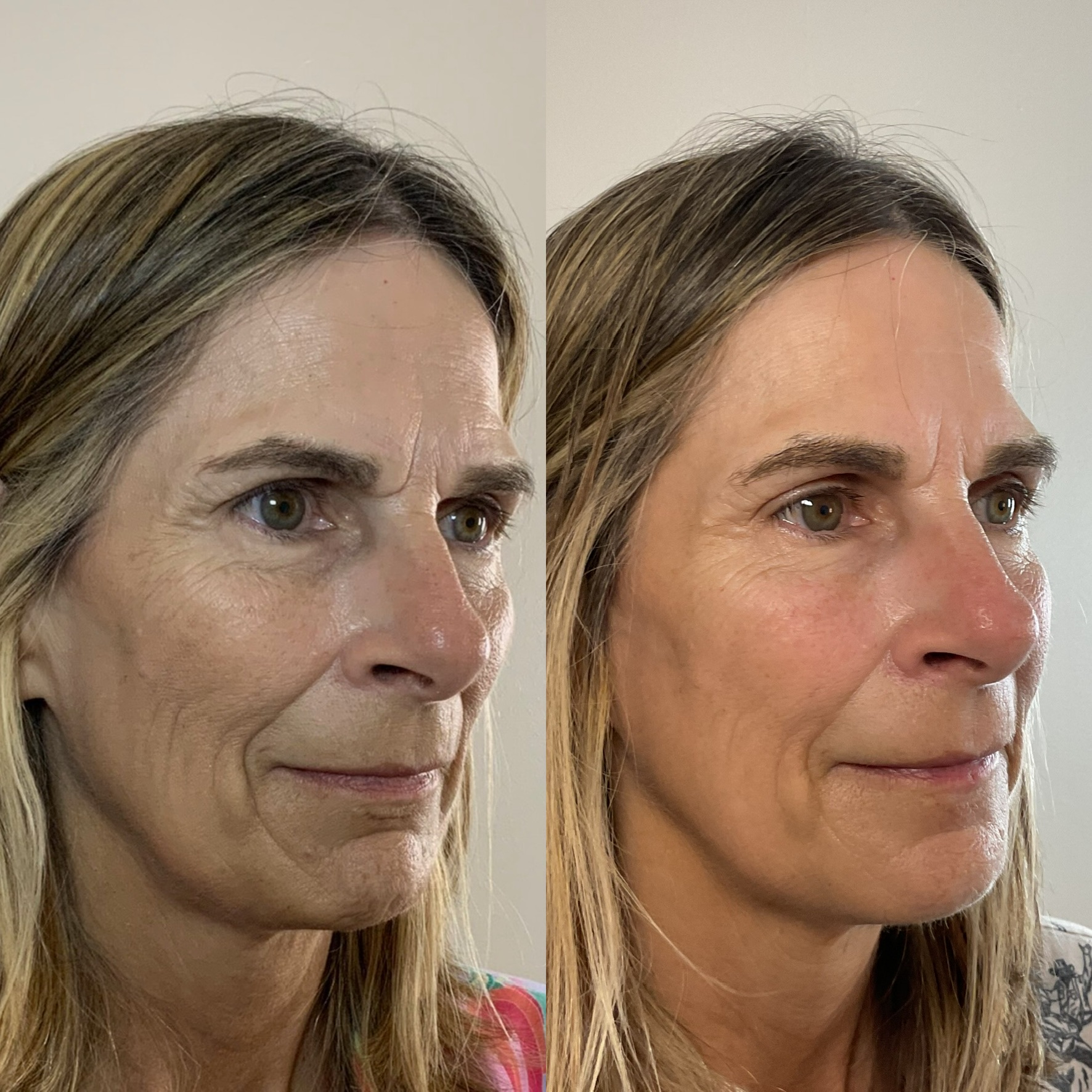 Full Facial Rejuvenation & Skin Tightening