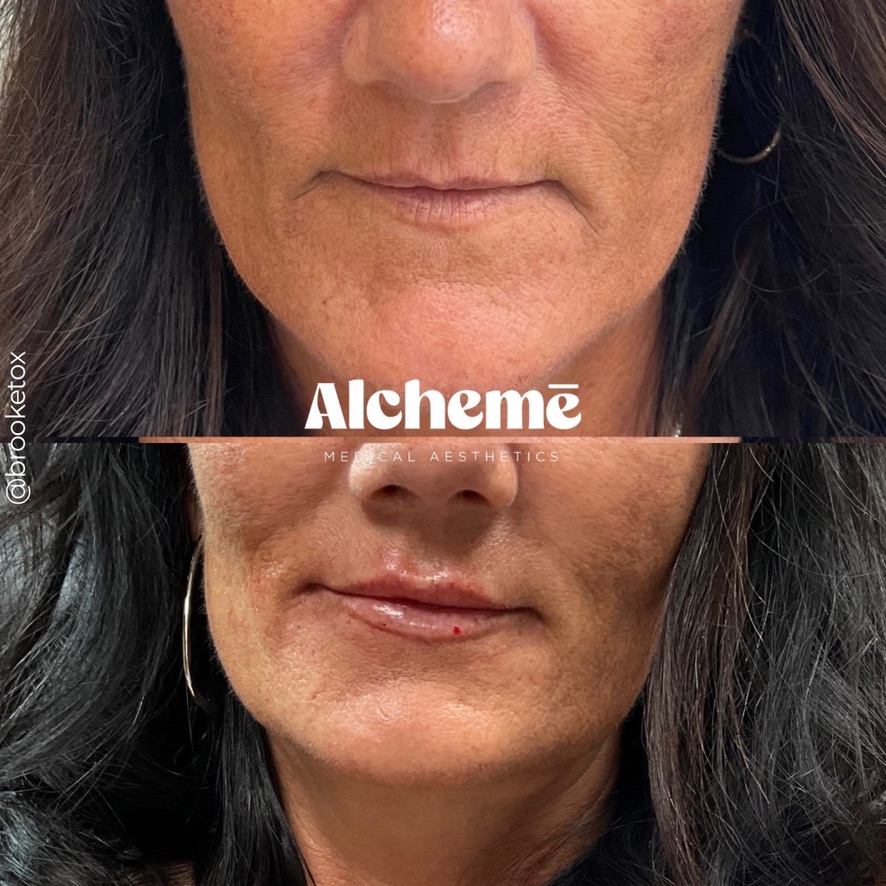 Dermal filler result 11