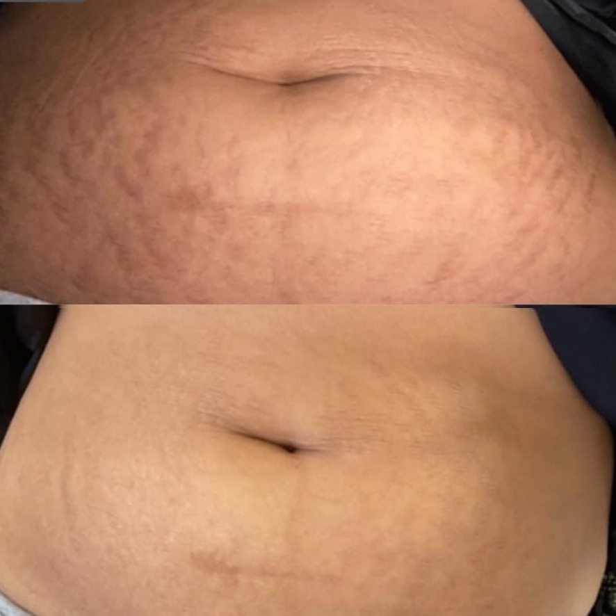 Dermal filler result 14