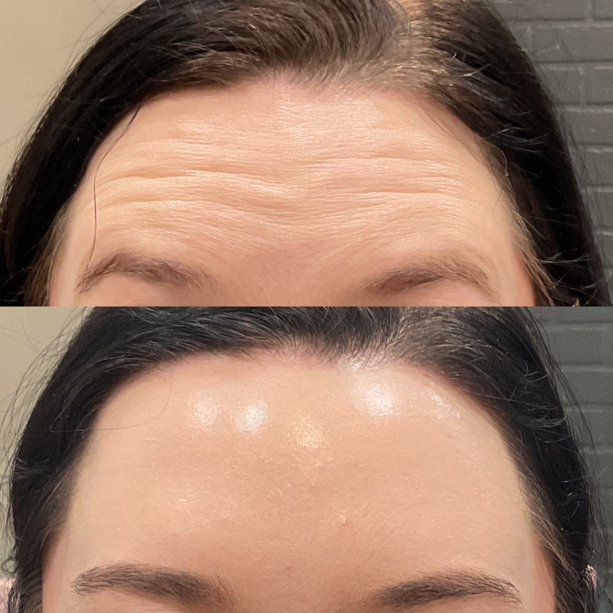 Dermal filler result 6