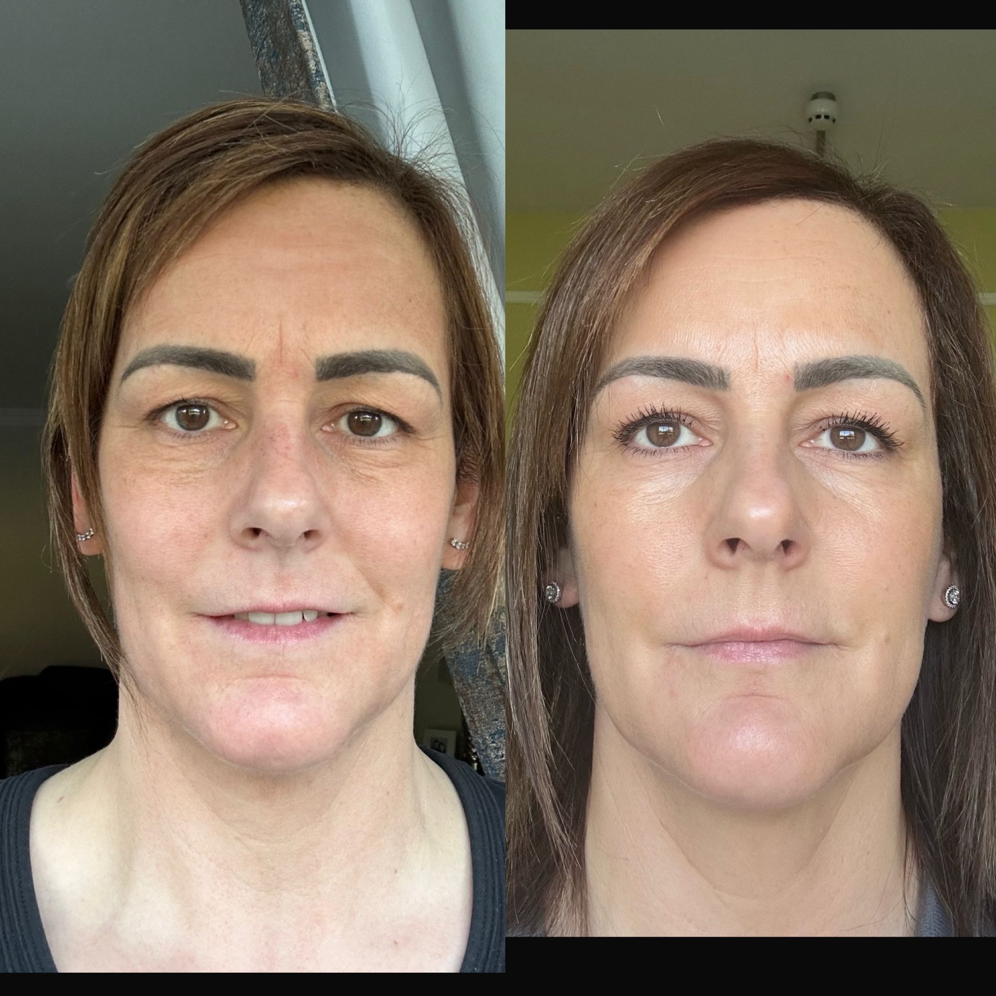 Before and after results - Skin Tone & Pore Refinement