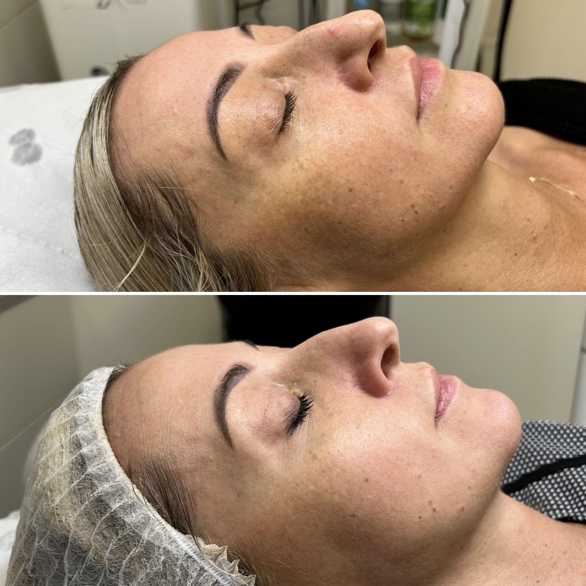 Before and after results - Cheek Contouring & Plumpness