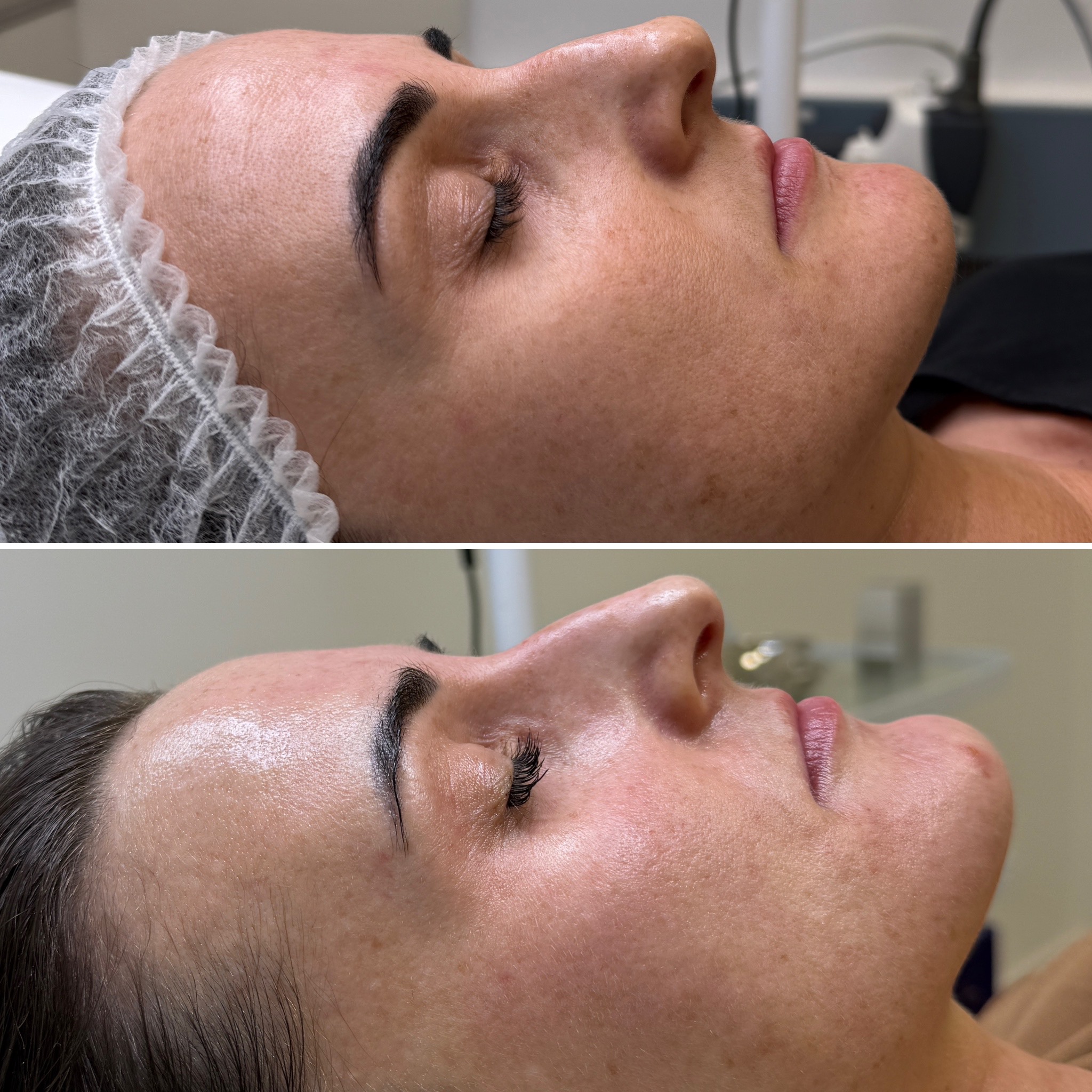 Before and after results - Jawline & Cheek Texture