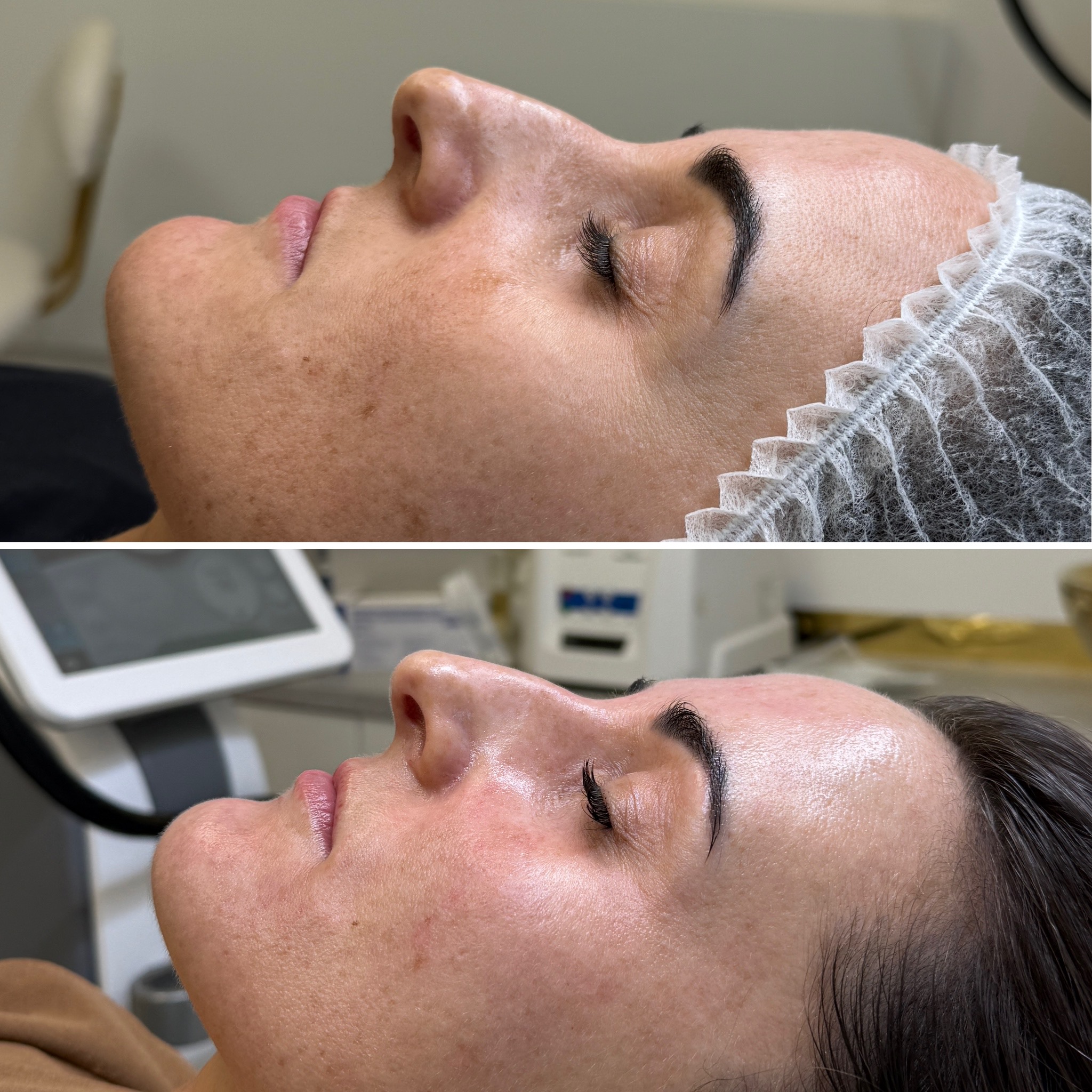 Before and after results - Full Face Glow & Radiance