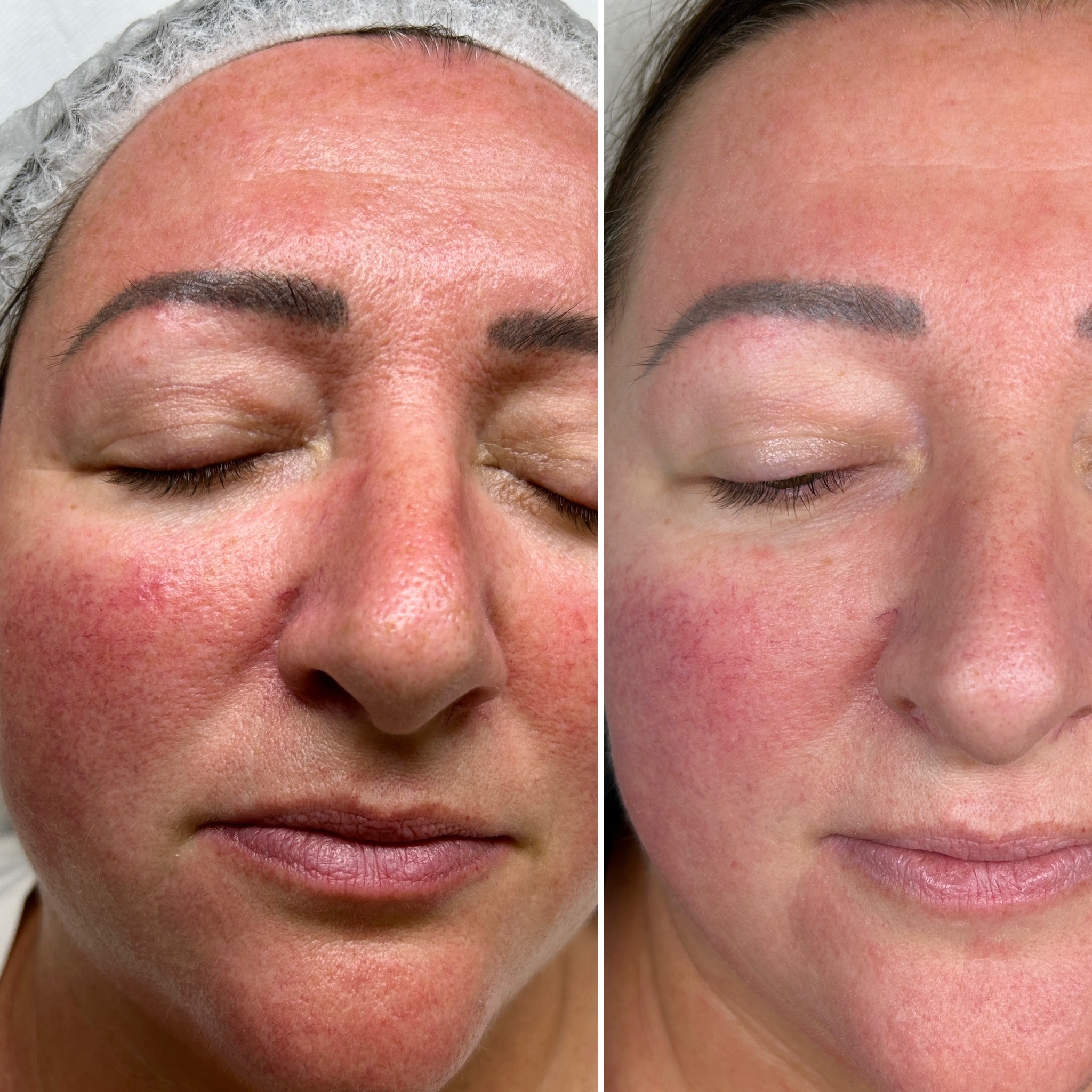 Before and after results - Redness, Rosacea & Texture Relief