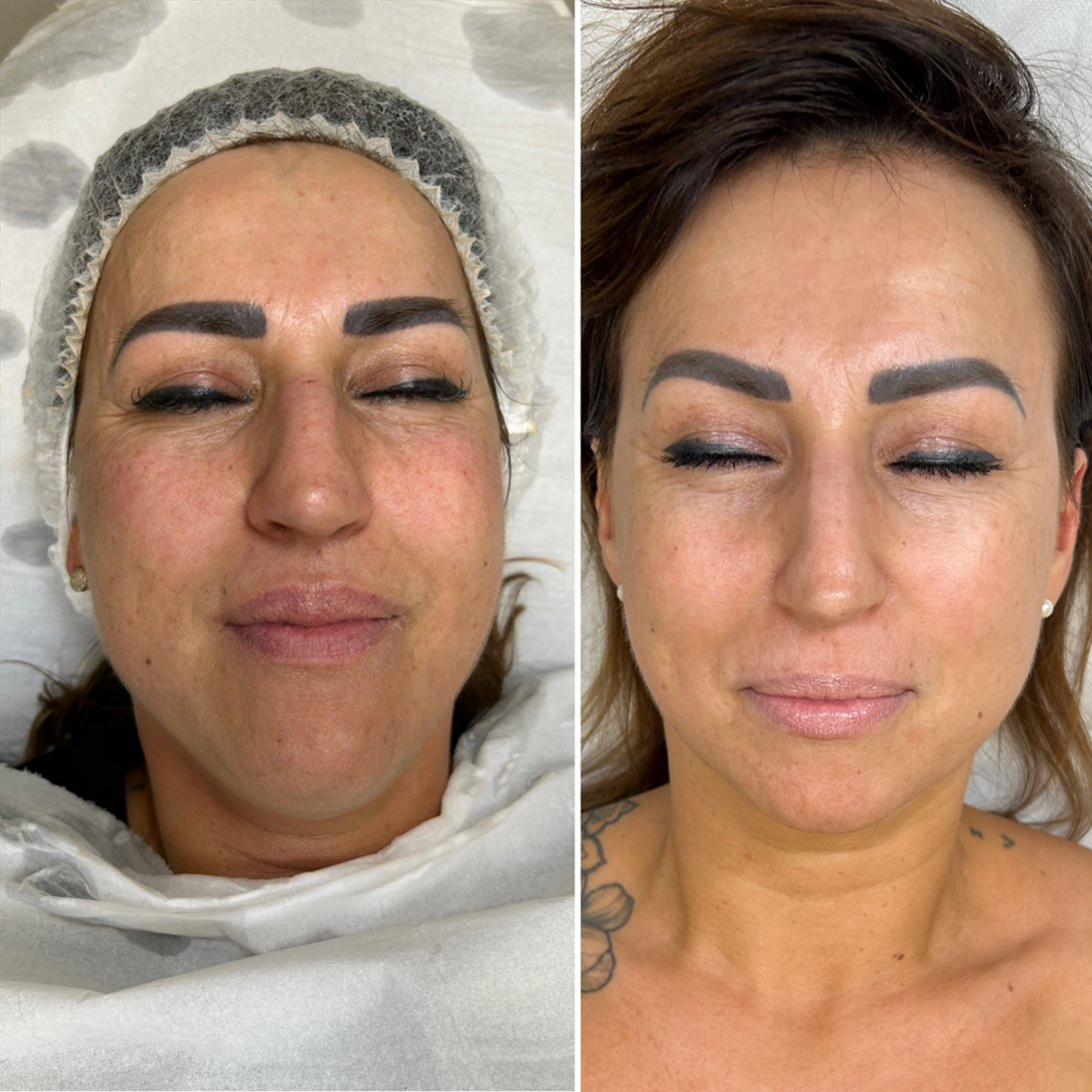 Before and after results - Pigmentation & Wrinkle Smoothing