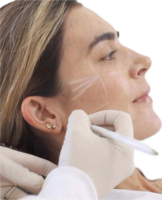 Bioestimuladores de colágeno