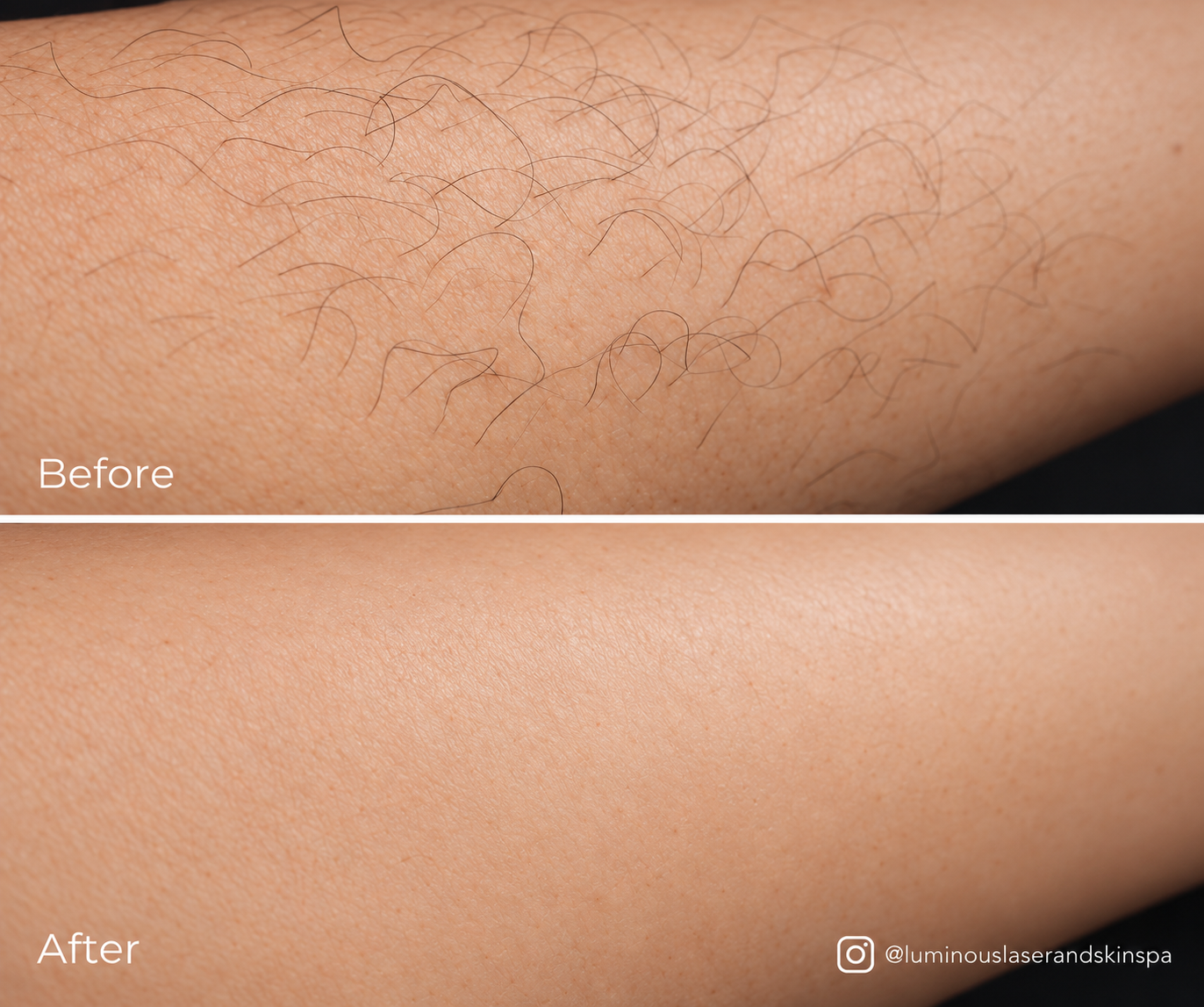 Arms before and after laser hair removal
