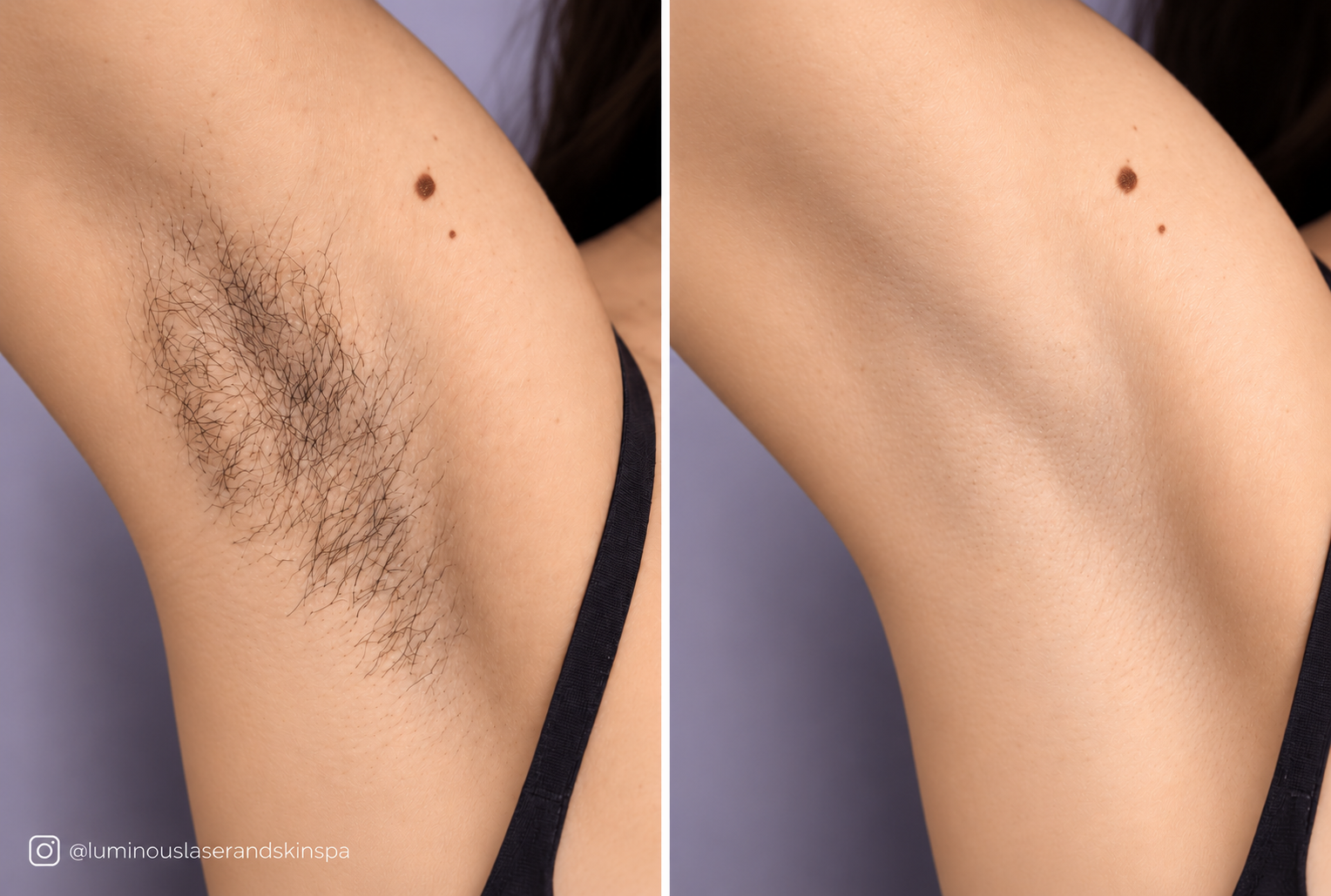 Underarms before and after laser hair removal