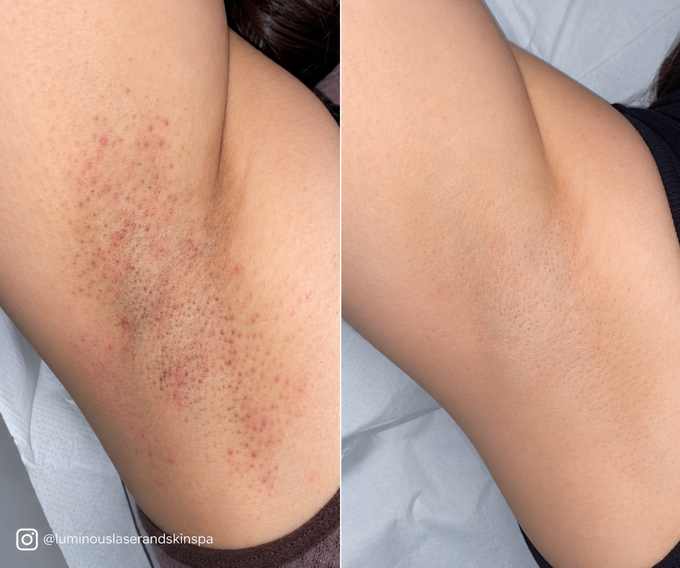 Underarms before and after laser hair removal