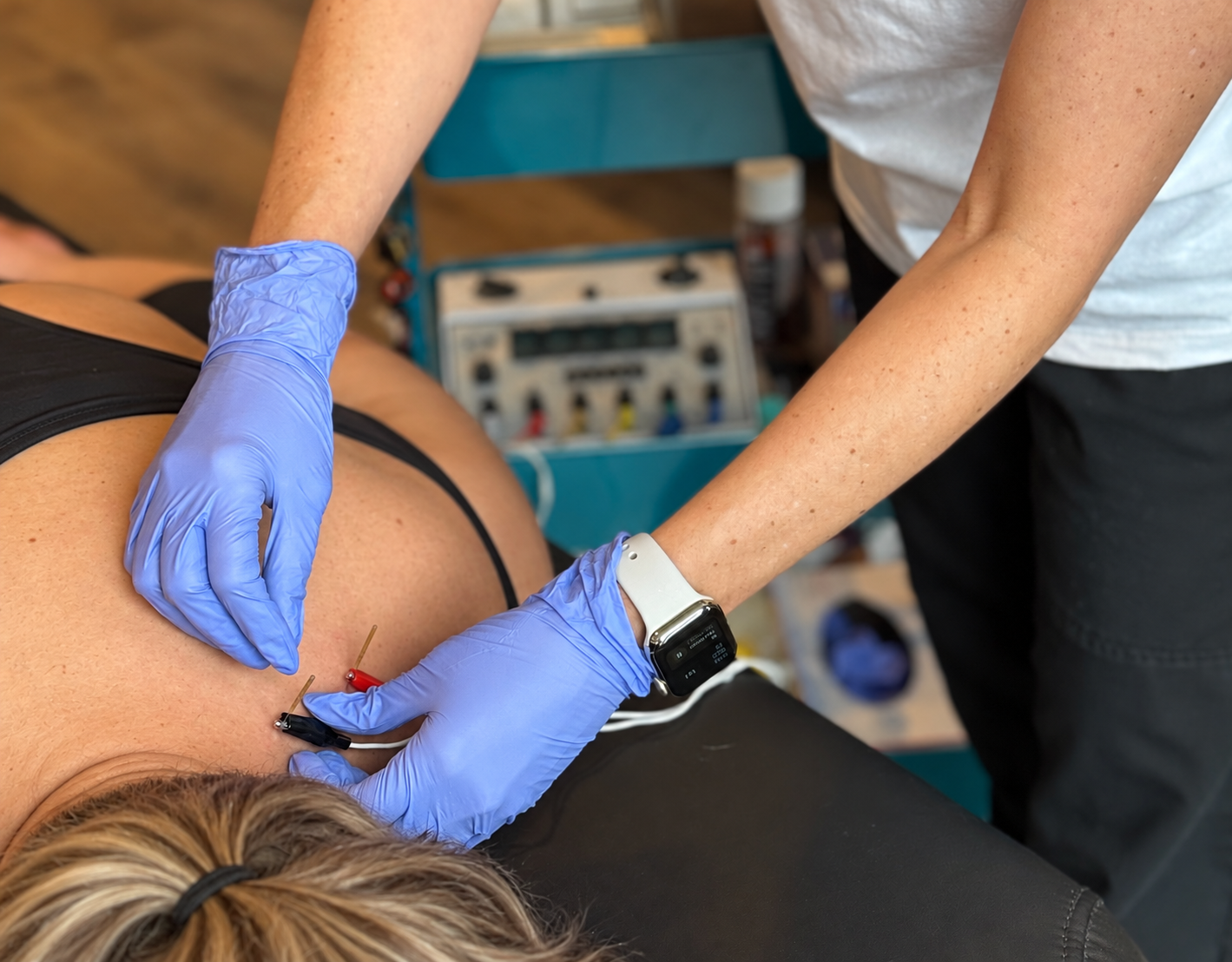 Dry needling treatment with electro-stimulation at Embodiment Health & Wellness