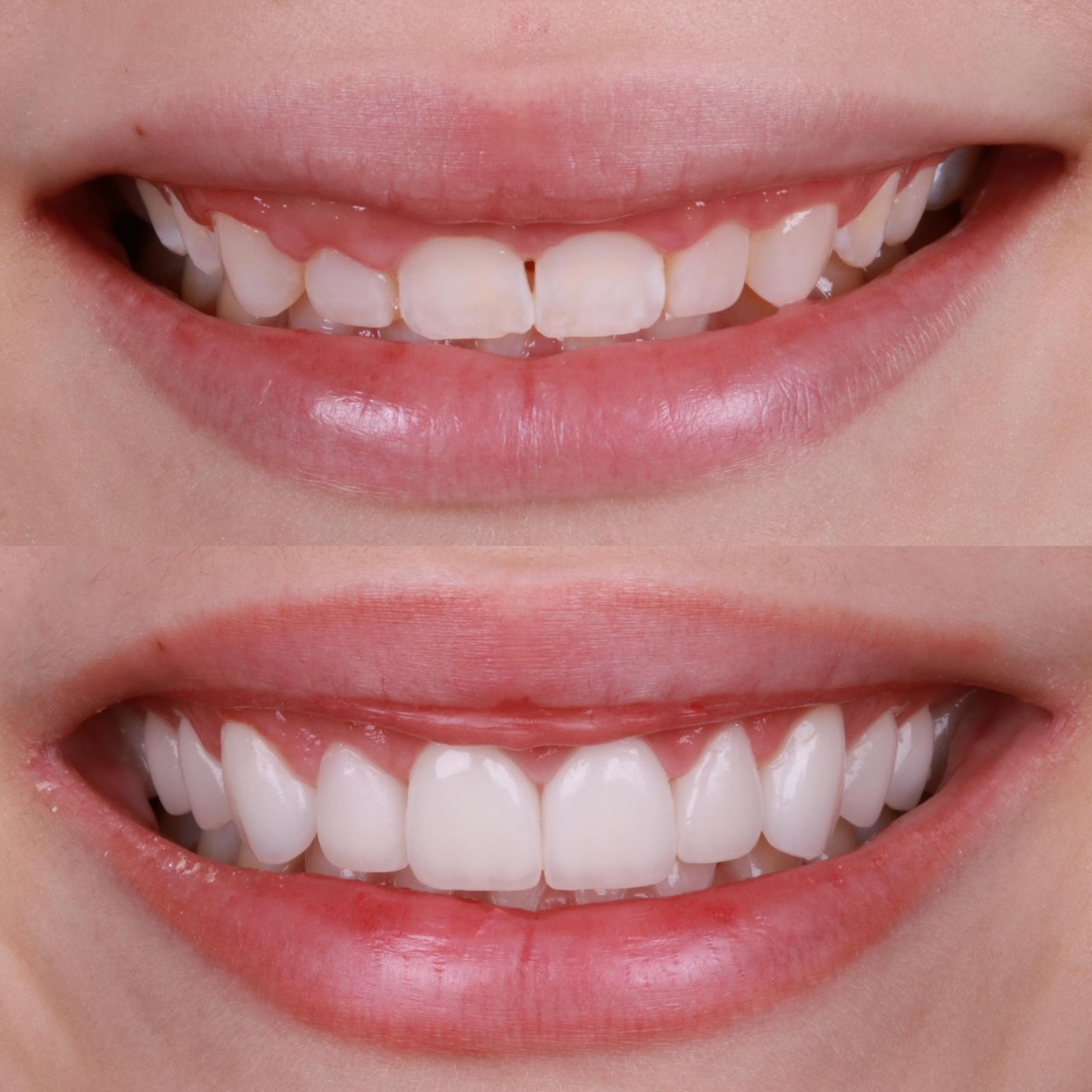 Fechamento de Diastema & Proporção - Caso 2