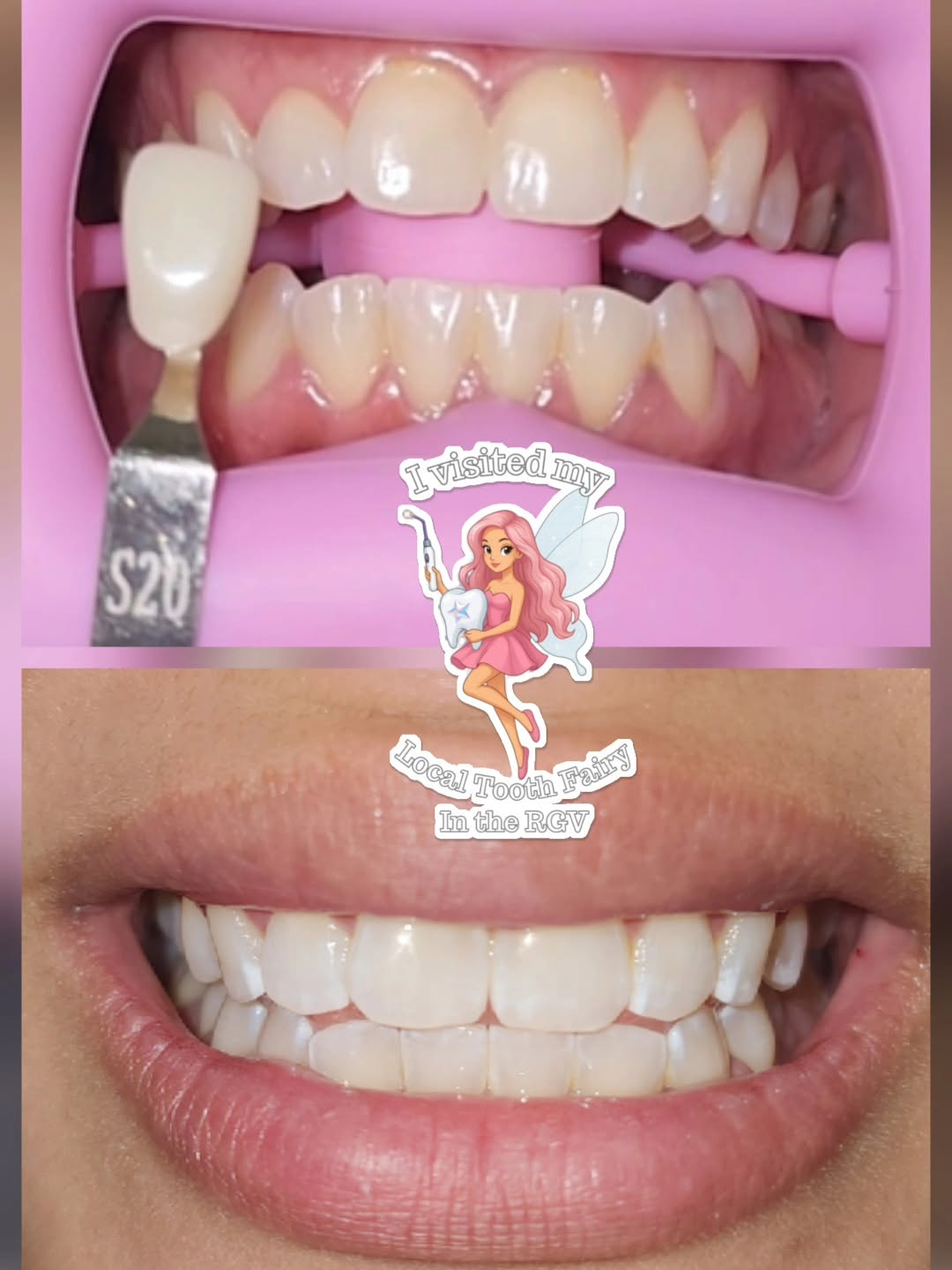 Before and after teeth whitening shade comparison tab
