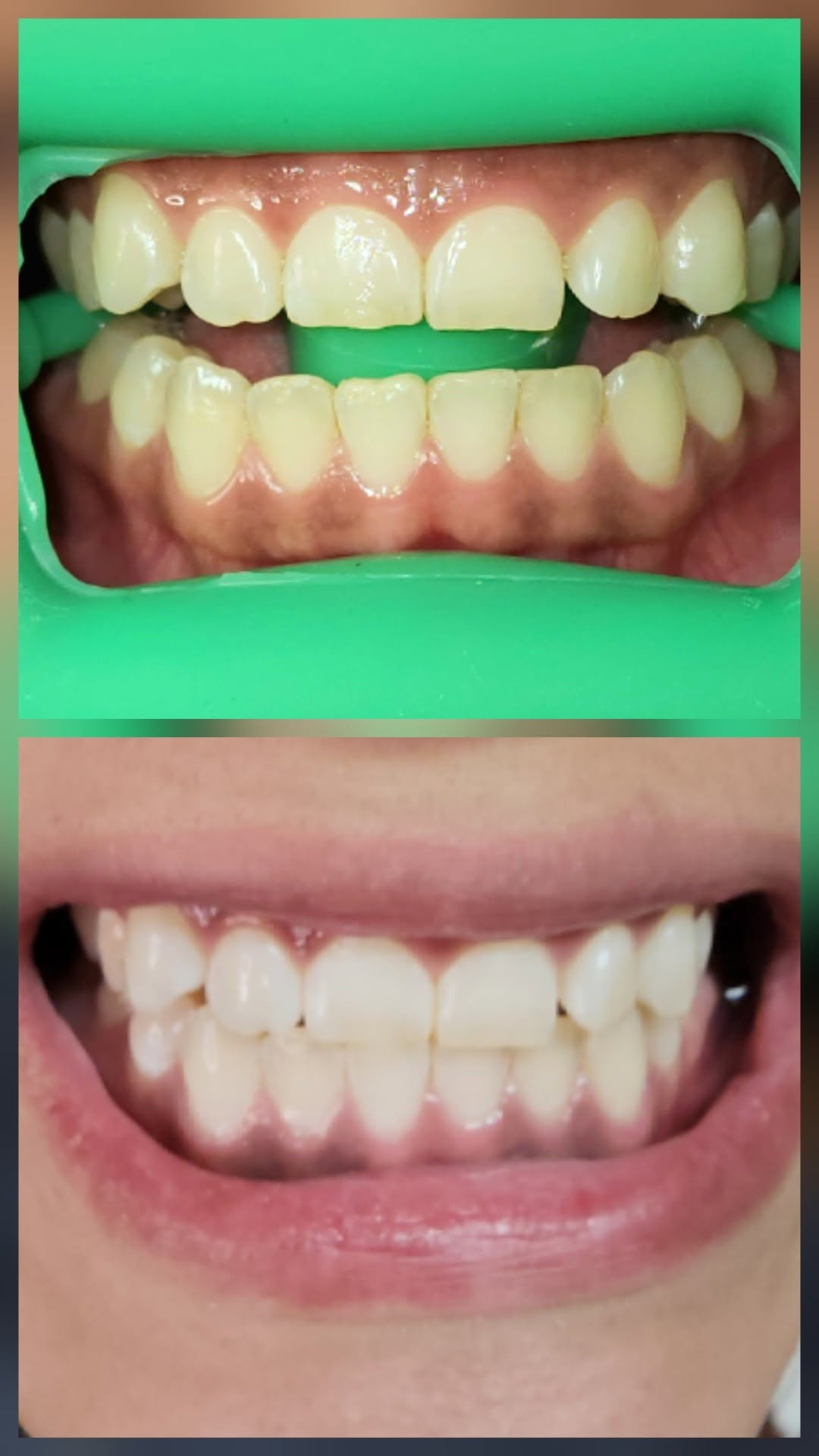 Clinical shade guide comparison showing brightened enamel