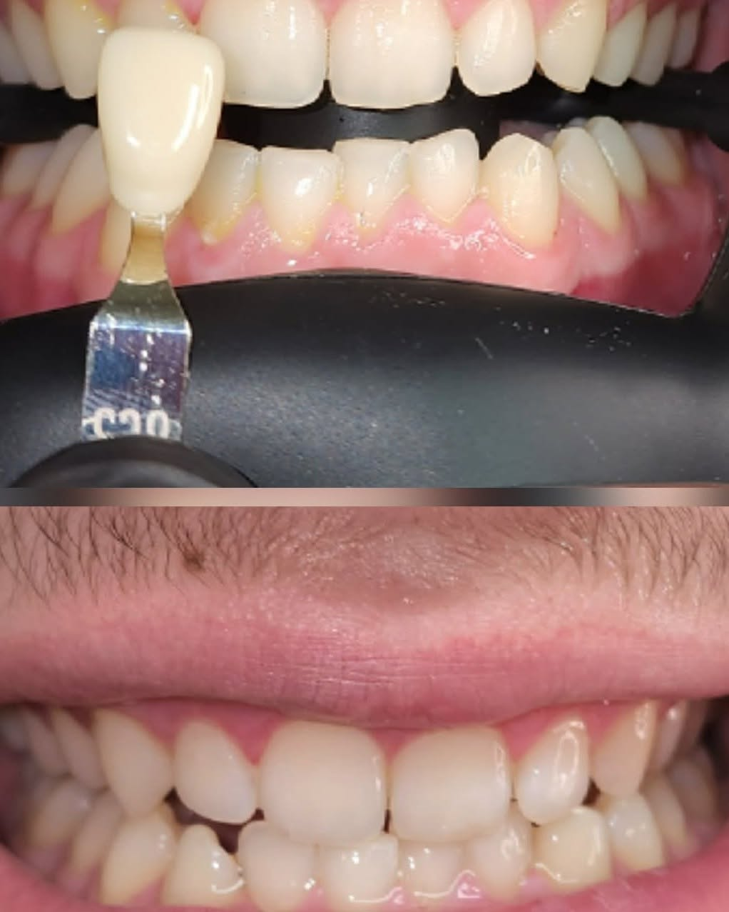 Teeth whitening shade guide result with RDA supervision