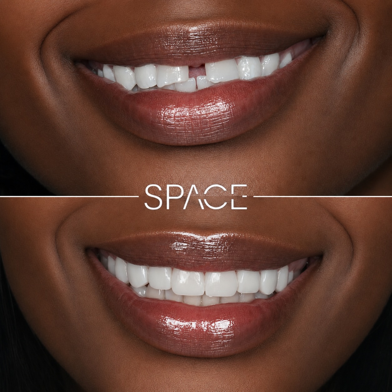 Diastema Closure & Edge Recontouring — Space Dental composite bonding transformation