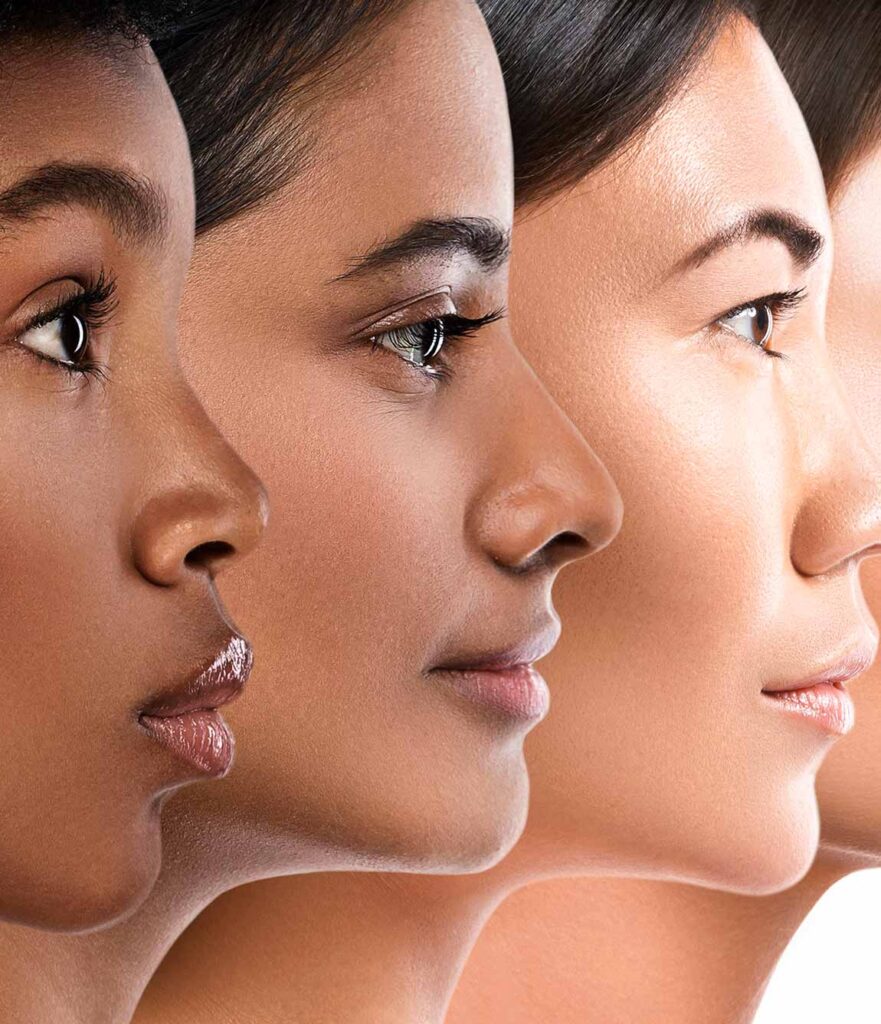 Acne & Scarring