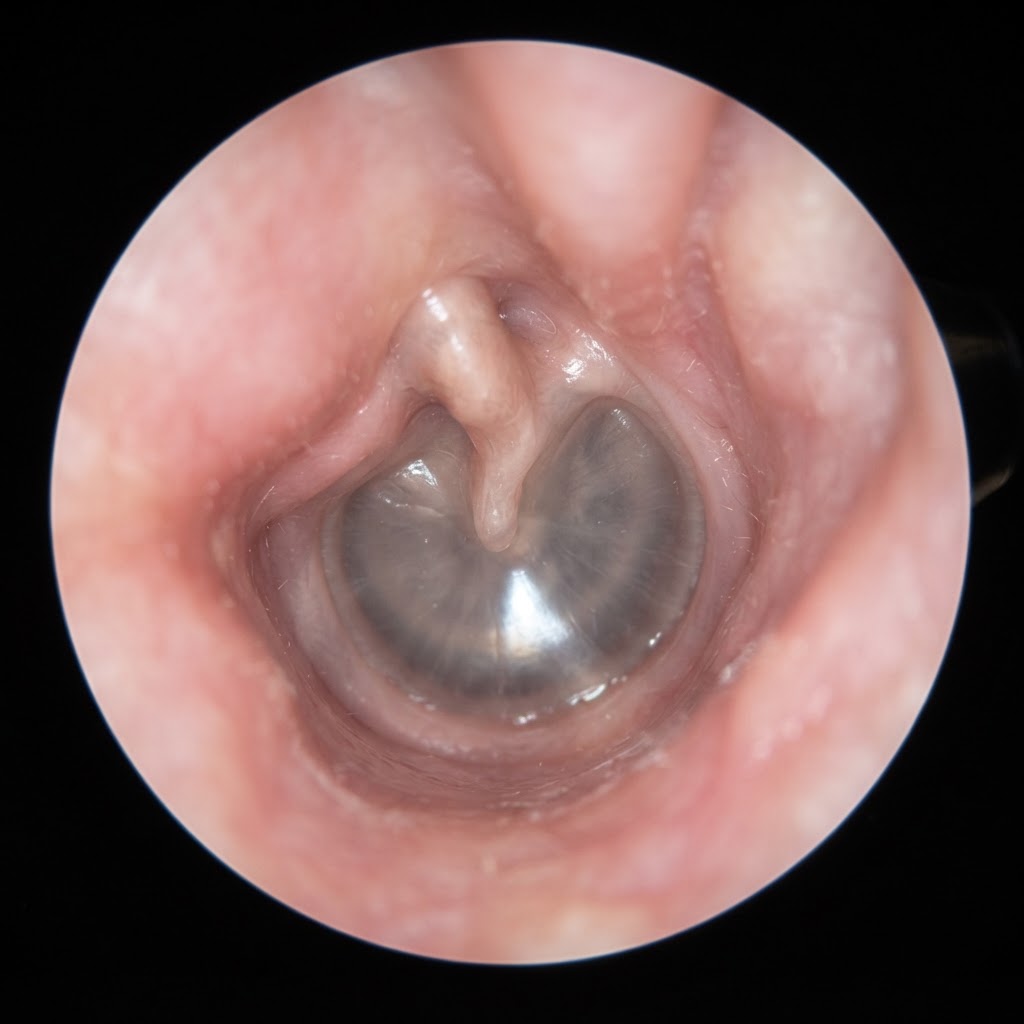 Normal ear canal
