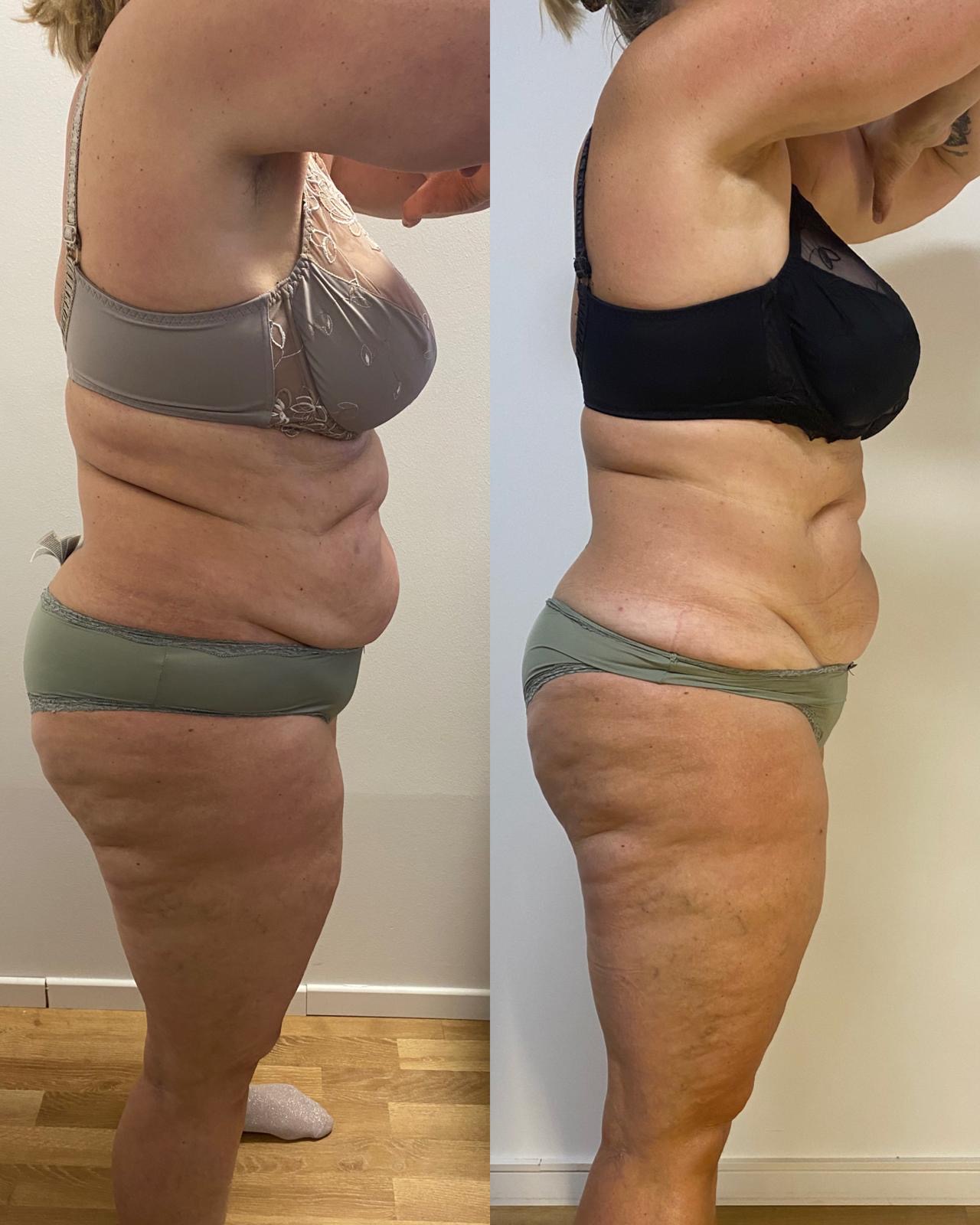 Frauen – Ergebnis 1 – Profilansicht Bauch & Oberschenkel