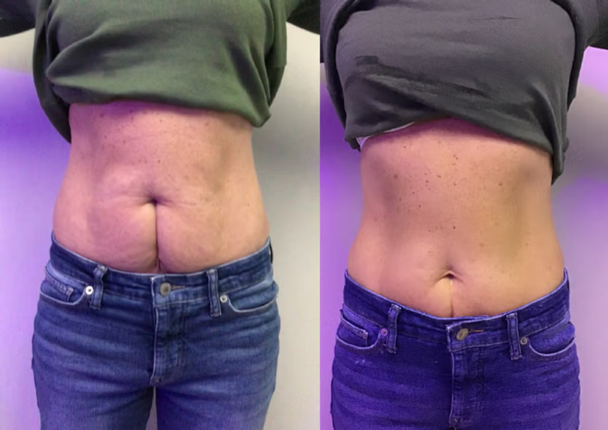 Abdominal contouring