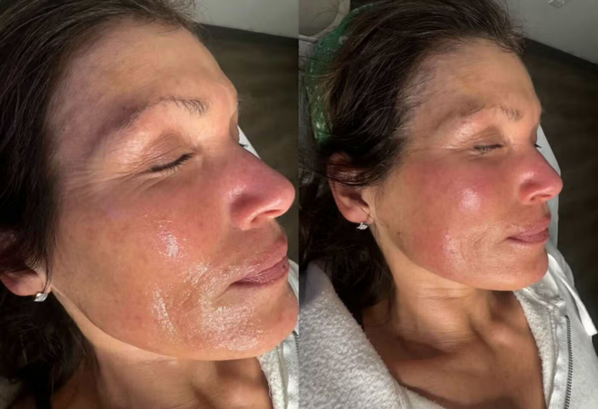 Facial rejuvenation & tone